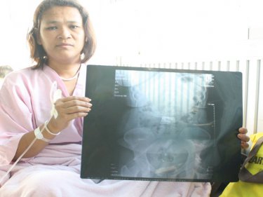 Authaiwan Maneetong with the Phuket x-ray showing her odd condition