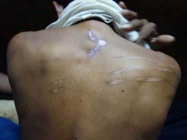 Ismail's back, with candle burns and cuts displayed, on Phuket last night