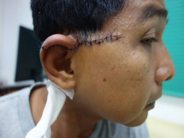 Knife victim Reno almost lost his ear in a Phuket beach attack