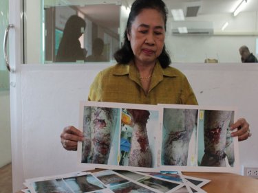 Benjarat Eakpaboon shows her son's wounds, inflicted by pitbulls