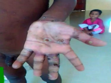 The seven-year-old shows his hand, infected in a secret jungle camp