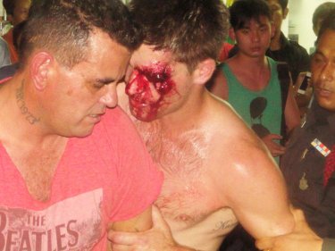 An injured Australian after the wild Patong brawl that put two in hospital