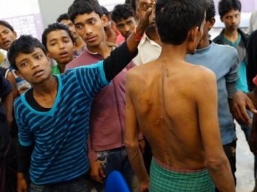 A Rohingya shows beatings received off the Burma-Thai coast