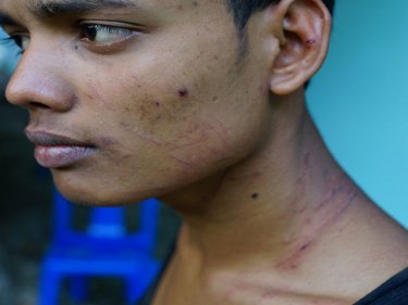 A Rohingya shows scars from a wound he says was inflicted by kidnappers